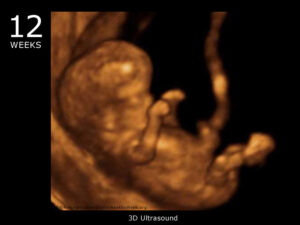 12wk-3d-ultrasound